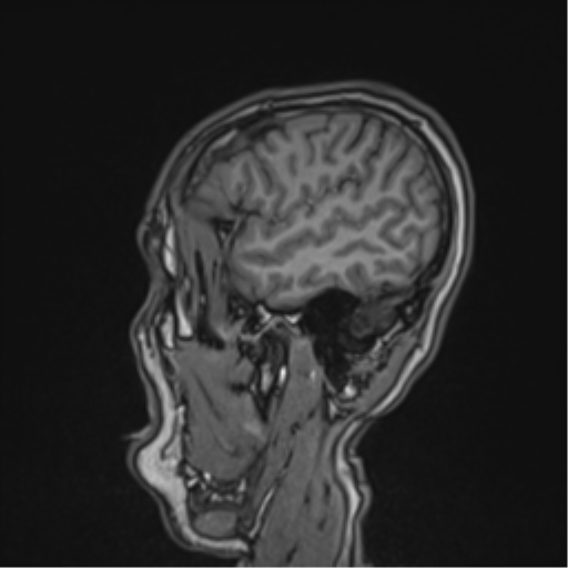 Cerebral fat embolism (Radiopaedia 57697-64639 Sagittal T1 40).png