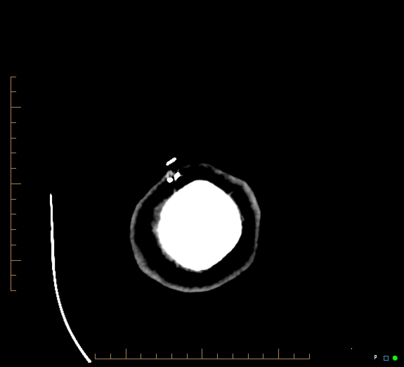 Cerebral fat embolism (Radiopaedia 85521-101220 Axial non-contrast 59).jpg