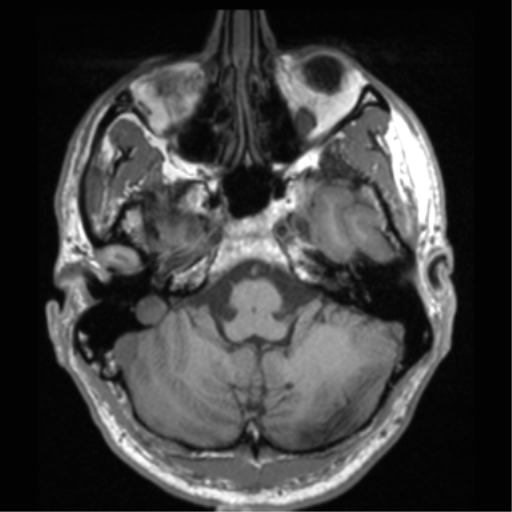 Cerebral hemorrhagic contusions- temporal evolution (Radiopaedia 40224-42757 Axial T1 17).png