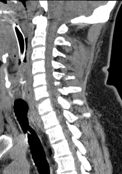 Cerebral hemorrhagic contusions and cervical spine fractures (Radiopaedia 32865-33841 G 61).jpg