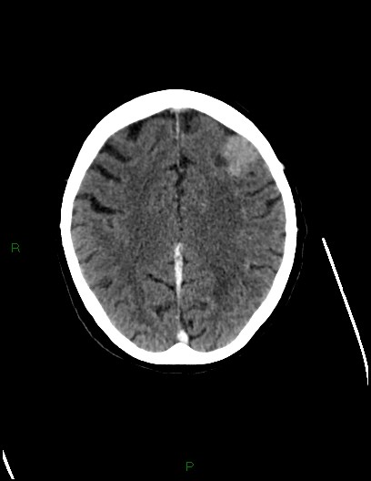 Cerebral metastases - ependymal and parenchymal (Radiopaedia 79877-93131 Axial C+ delayed 59).jpg