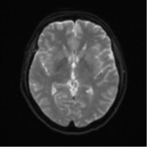 Cerebral metastases mimicking abscesses (Radiopaedia 45841-50131 Axial DWI 15).png