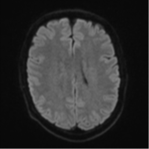 Cerebral metastasis - colorectal adenocarcinoma (Radiopaedia 50394-55765 Axial DWI 45).png