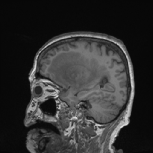 Cerebral metastasis to basal ganglia (Radiopaedia 81568-95413 Sagittal T1 52).png