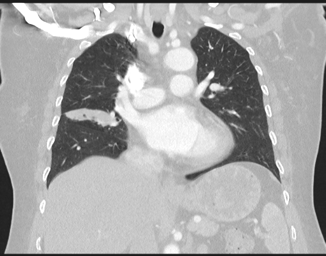 File:Cerebral metastasis to basal ganglia (Radiopaedia 81568-95414 Coronal lung window 43).png