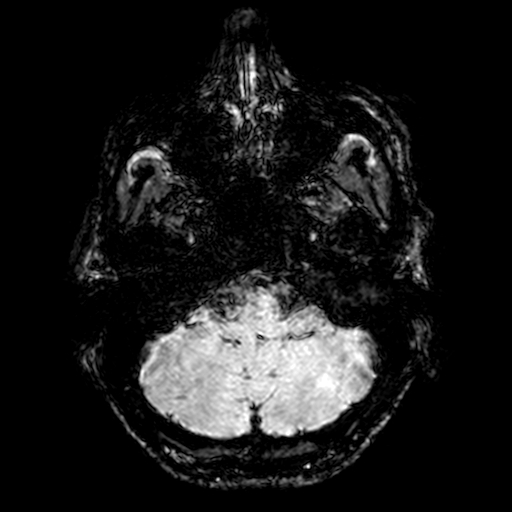 Cerebral parenchymal arteriovenous malformation (Radiopaedia 27280-27456 Axial SWI 9).jpg