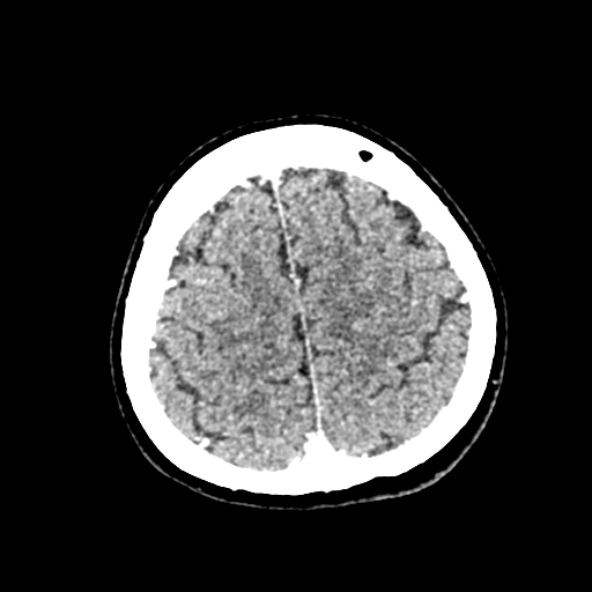 Cerebral ring enhancing lesions - cerebral metastases (Radiopaedia 44922-48818 B 234).jpg