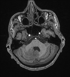 Cerebral toxoplasmosis (Radiopaedia 43956-47461 Axial T1 18).jpg