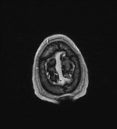 Cerebral toxoplasmosis (Radiopaedia 43956-47461 Axial T1 C+ 73).jpg