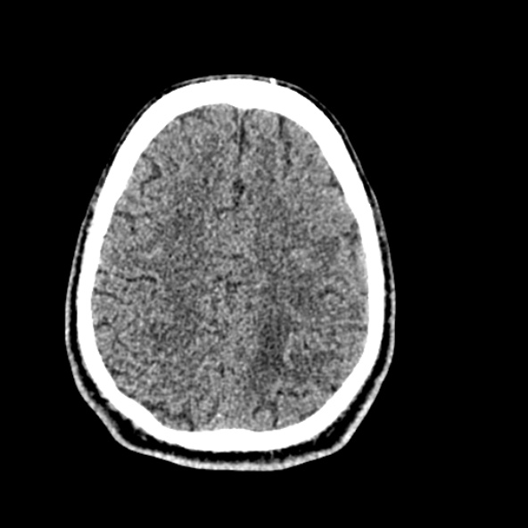 Cerebral toxoplasmosis (Radiopaedia 53993-60131 Axial non-contrast 60).jpg