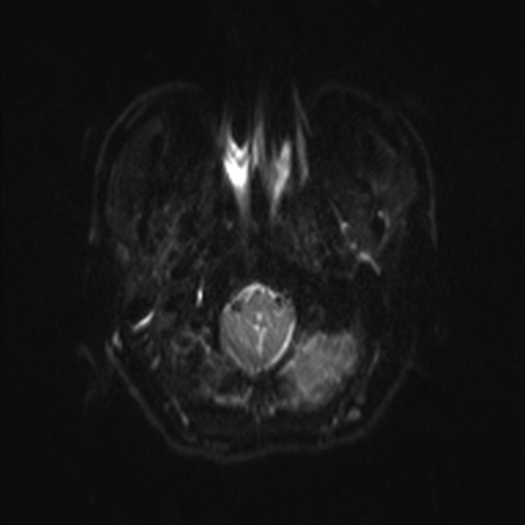 Cerebral toxoplasmosis (Radiopaedia 53993-60132 Axial DWI 2).jpg
