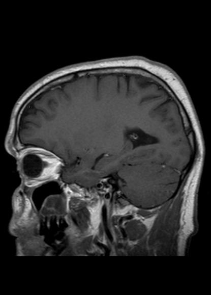 File:Cerebral toxoplasmosis (Radiopaedia 77955-90289 Sagittal T1 C+ 1).jpg