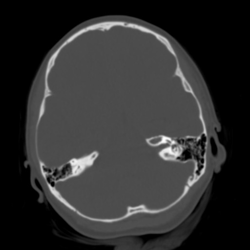 File:Cerebral tuberculosis with dural sinus invasion (Radiopaedia 60353-68018 Axial bone window 16).jpg