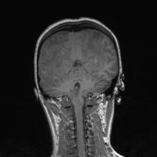 Cerebral tuberculosis with dural sinus invasion (Radiopaedia 60353-68090 Coronal T1 131).jpg