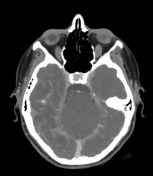 Cerebral venous hemorrhagic infarction (Radiopaedia 38461-40550 Axial MIP VENOGRAM 18).png
