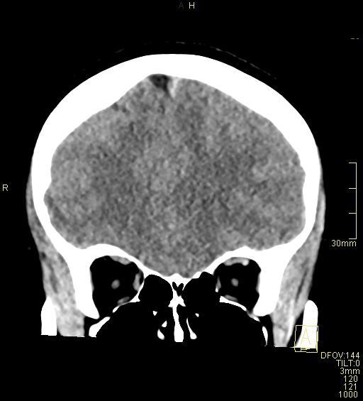 Cerebral venous sinus thrombosis (Radiopaedia 91329-108965 Coronal non-contrast 15).jpg
