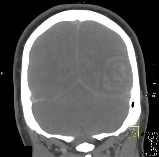 Cerebral venous sinus thrombosis (Radiopaedia 91329-108965 Coronal venogram 70).jpg