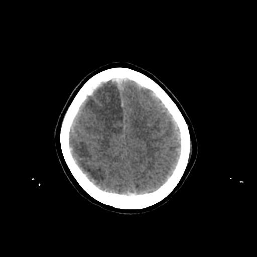 File:Cerebral venous throbmosis - hemorrhagic venous infarction (Radiopaedia 87318-103613 Axial non-contrast 143).jpg
