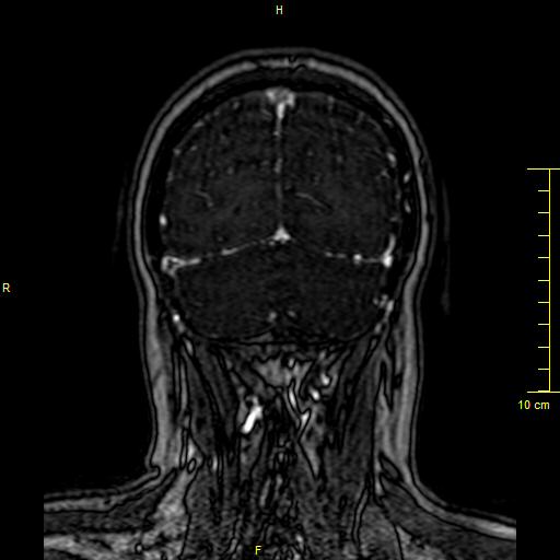 Cerebral venous thrombosis (Radiopaedia 23288-23351 MRV 144).JPG