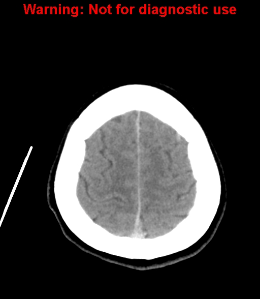 File:Cerebral venous thrombosis (Radiopaedia 37224-38992 Axial non-contrast 25).jpg