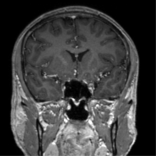 Cerebral venous thrombosis (Radiopaedia 38392-40469 Coronal T1 C+ 57).png