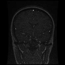 Cerebral venous thrombosis - ulcerative colitis (Radiopaedia 66049-75219 Coronal MRV 73).jpg