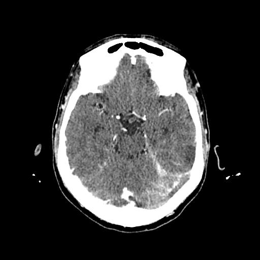 Cerebral venous thrombosis with venous hemorrhagic infarct (Radiopaedia 90354-107660 Axial with contrast 62).jpg