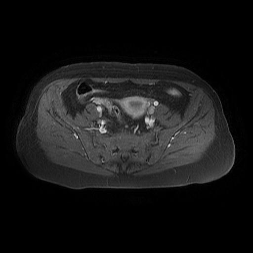 File:Cervical carcinoma (Radiopaedia 67644-77047 Axial T1 C+ fat sat 7).jpg