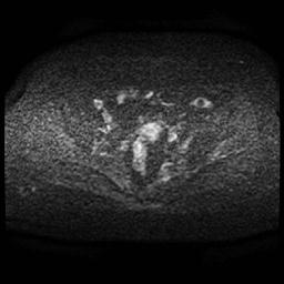 File:Cervical carcinoma (Radiopaedia 70924-81132 Axial DWI 43).jpg