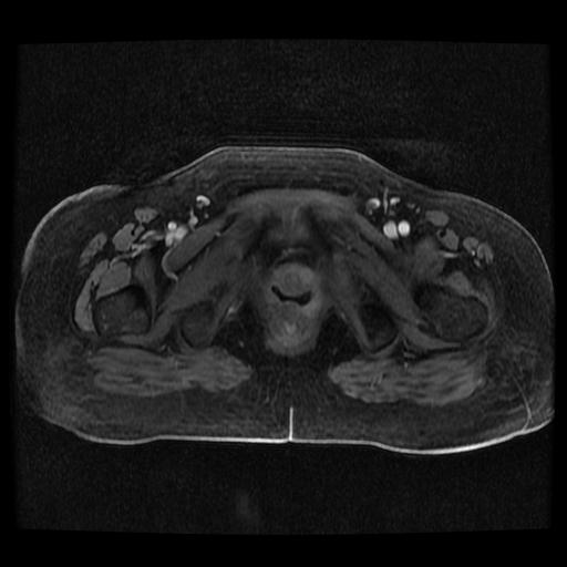 Cervical carcinoma (Radiopaedia 70924-81132 Axial T1 C+ fat sat 116).jpg