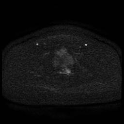 Cervical carcinoma (Radiopaedia 85405-101028 Axial DWI 67).jpg