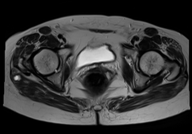 File:Cervical carcinoma (Radiopaedia 88312-104943 Sagittal T1 16).jpg