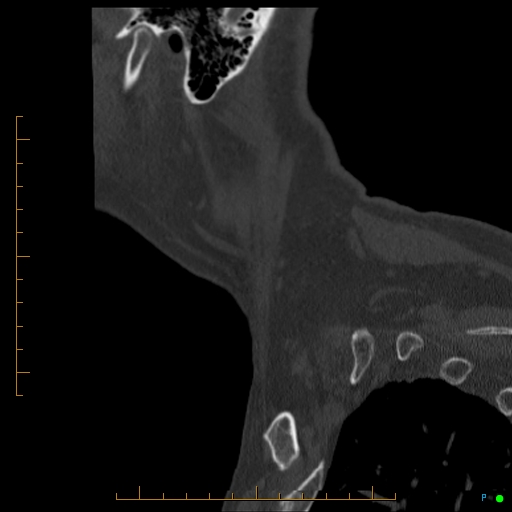 Cervical spine fracture - ankylosing spondylitis (Radiopaedia 76835-88706 Sagittal bone window 7).jpg