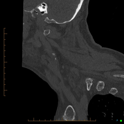Cervical spine fracture - ankylosing spondylitis (Radiopaedia 76835-88706 Sagittal bone window 94).jpg