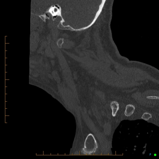 Cervical spine fracture - ankylosing spondylitis (Radiopaedia 76835-88706 Sagittal bone window 97).jpg