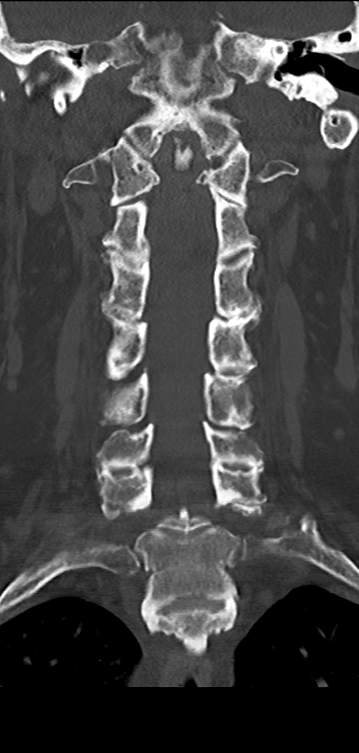 Cervical spine fracture - chalk stick (Radiopaedia 39116-41323 Coronal bone window 25).png