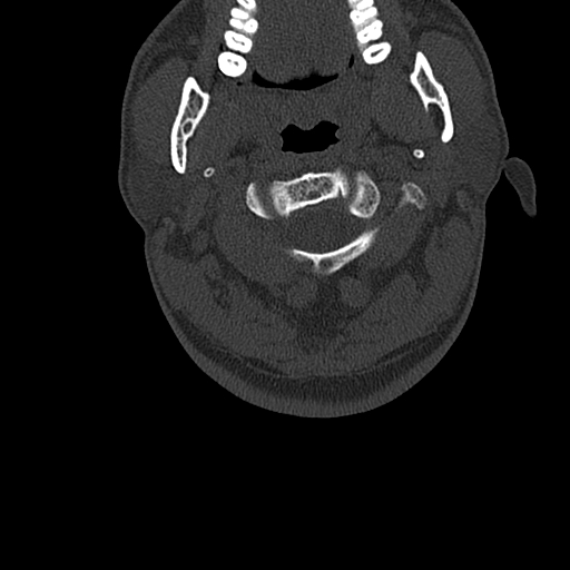 File:Cervical spine trauma with tear drop fracture and perched facet joint (Radiopaedia 53989-60127 Axial bone window 25).jpg