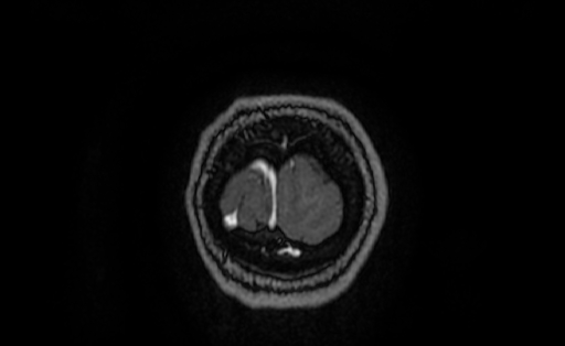 File:Cervical spondylodiscitis and calvarial hemangioma (Radiopaedia 64317-73103 Coronal T1 C+ 74).jpg
