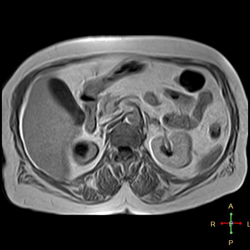 File:Cervical stump squamous cell carcinoma (Radiopaedia 48049-52858 H 5).jpg