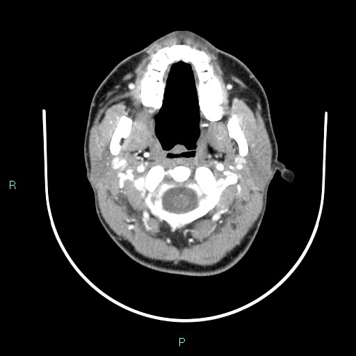 Cervical thymic cyst (Radiopaedia 88632-105335 B 92).jpg