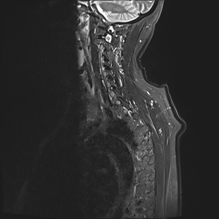 File:Cervical tumor-like myelopathy due to Type V dAVF (Radiopaedia 82461-96604 Sagittal STIR 15).jpg