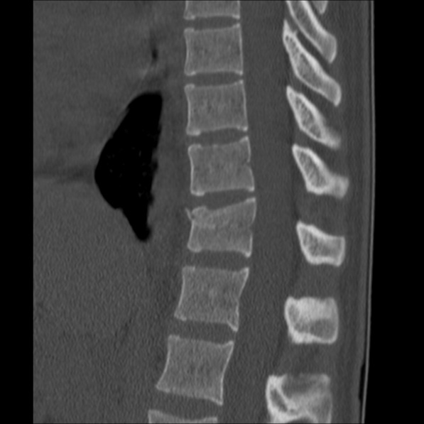 Chance fracture (Radiopaedia 36521-38081 Sagittal bone window 32).jpg