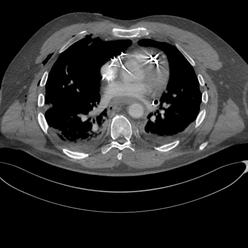 File:Chest multitrauma - aortic injury (Radiopaedia 34708-36147 A 170).png