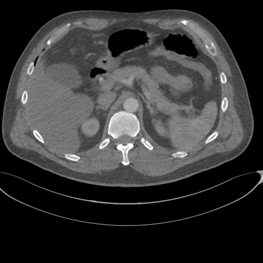 File:Chest multitrauma - aortic injury (Radiopaedia 34708-36147 A 302).png