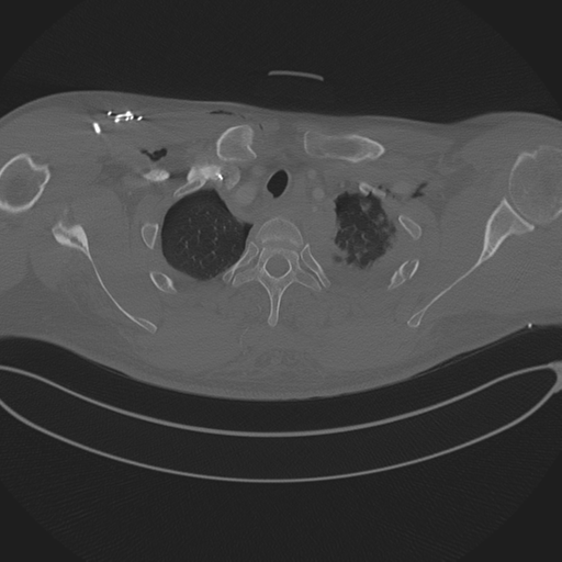 Chest multitrauma - aortic injury (Radiopaedia 34708-36147 Axial bone window 44).png