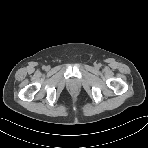 Cholecystitis with focal perforation and hepatic abscess (Radiopaedia 37189-38945 Axial non-contrast 87).png