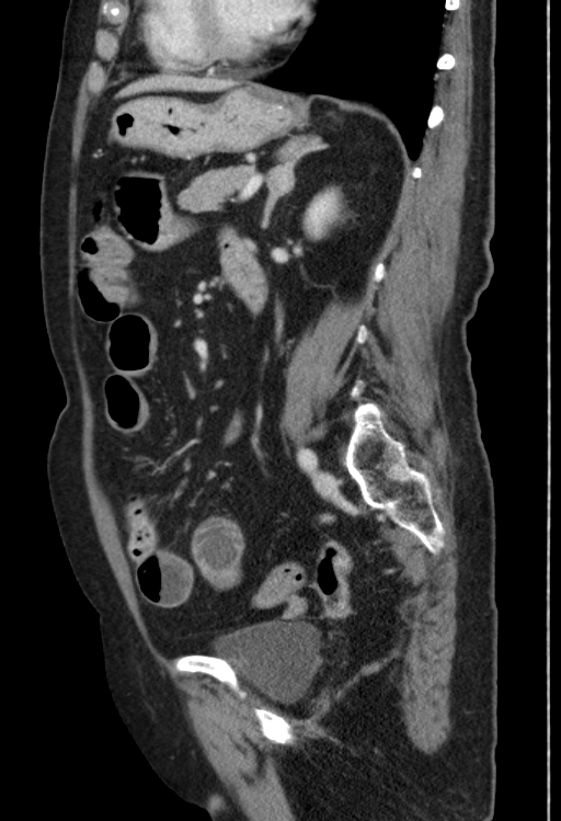 Cholecystoduodenal fistula due to calculous cholecystitis with gallstone migration (Radiopaedia 86875-103077 F 23).jpg