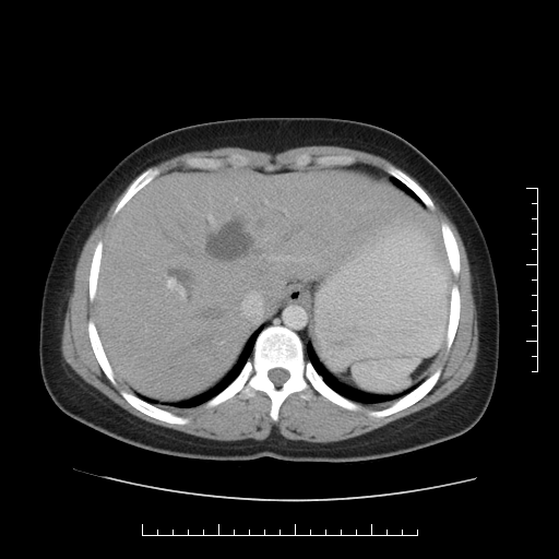 File:Choledochal cyst with chronic calcific pancreatitis (Radiopaedia 18245-18061 A 3).png