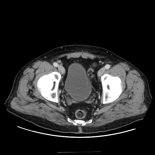 Choledocholiathiasis with normal caliber common bile duct (Radiopaedia 75368-86632 A 174).jpg