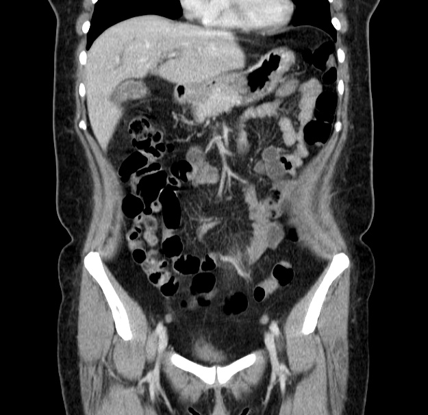 Choledocholithiasis on CT and MRI (Radiopaedia 24825-25087 C 18).jpg